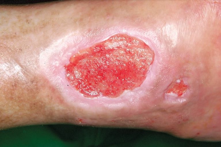 Diabetes and Wound Healing: Why Recovery Can Slow